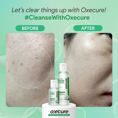 Oxe Cure Acne Clear Facial Cleanser – 120ml for Oily & Acne-Prone Skin