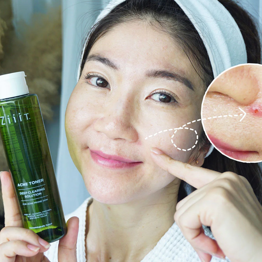 Ziiit Acne Toner - Clear and Refresh Your Skin 100ml