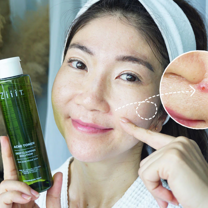 Ziiit Acne Toner - Clear and Refresh Your Skin 100ml