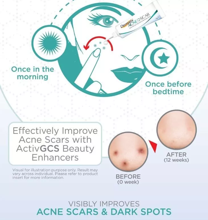 Dermatix Acne Scar Gel 5g – Advanced Treatment for Scars & Dark Spots